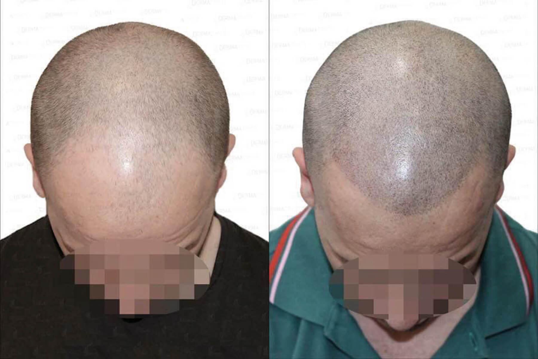 Kopfhautpigmentierung vorher-nachher